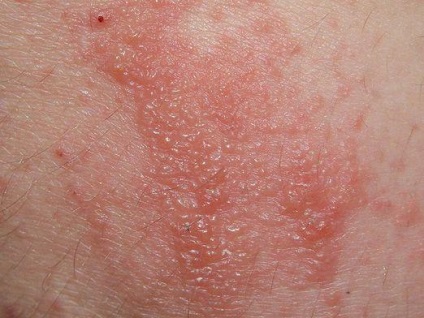A vénás dermatitis a lábon kezelt kenőcsök és népi jogorvoslati