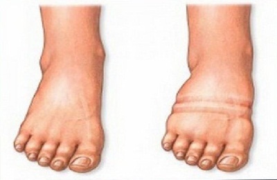 A vénás dermatitis a lábon kezelt kenőcsök és népi jogorvoslati