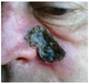 Típusú rák betegségek a bőr - melanóma, bazális sejtes karcinóma, kezelésére FTD - sebész