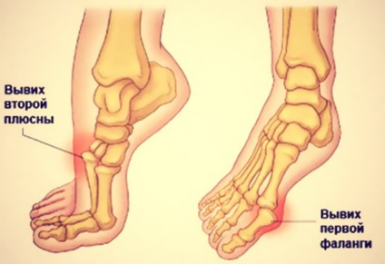 Вивих пальця на нозі симптоми і лікування