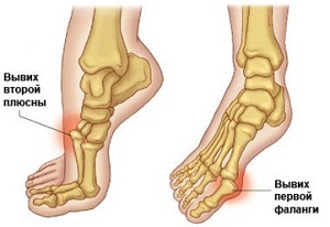 Kificamodott toe tünetek, elsősegély és alapvető a betegség kezelésében