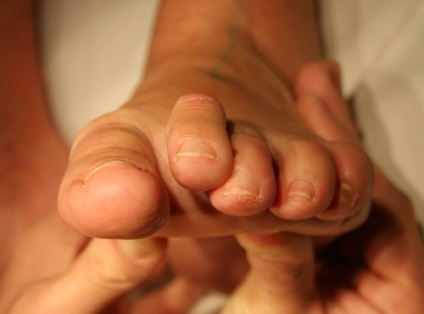 Kificamodott toe tünetek, elsősegély és alapvető a betegség kezelésében