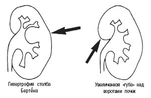 Jellemzői vesehipertrófiával (jellemző) Jellemzői vesehipertrófiával