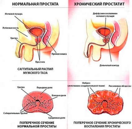 Prostatitis színpad 24 órás vizeletgyűjtés terhesség
