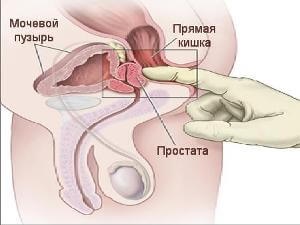Prostatitis krónikus)