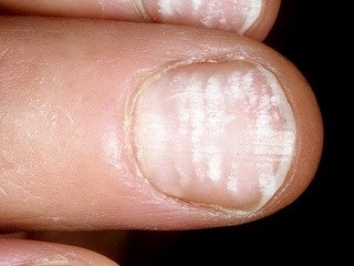 Nail betegség Leukonychia fotó, okozza az, kezelési módszerek
