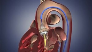 Aorta műbillentyű - Olcsó és utáni szívműtét
