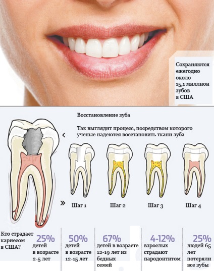 Kezelt fogak eltávolítása nélkül az ideg - periodontális betegség - fogászat - a betegségek listája
