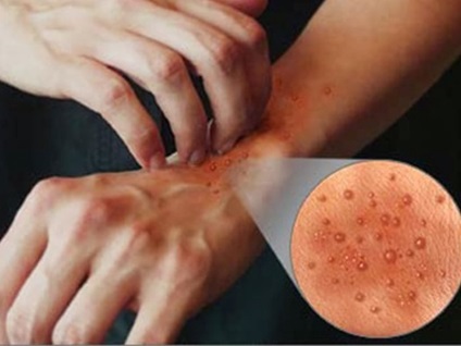 Viszkető bőrgyulladás tünetei és kezelése viszketés dermatitis