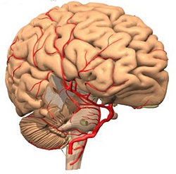 Atherothromboticus szélütés (szédülés, hányinger, hányás nystagmus) atherothromboticus szélütés