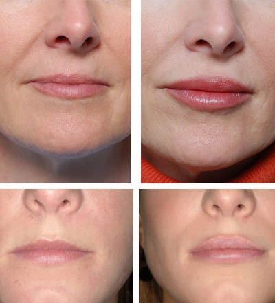 Botox ajkak válaszokat a betegek, ellenjavallatok és a lehetséges szövődmények előtti és utáni képek, ár