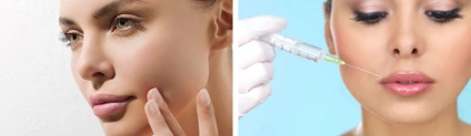 Botox ajkak válaszokat a betegek, ellenjavallatok és a lehetséges szövődmények előtti és utáni képek, ár