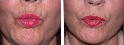 Botox ajkak, hogyan működik, és miben különbözik a töltőanyag