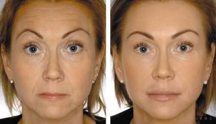 Botox ajkak javallatok és ellenjavallatok, hatása, a valós árak