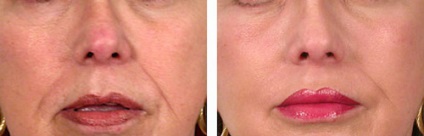 Botox ajkak javallatok és ellenjavallatok, hatása, a valós árak