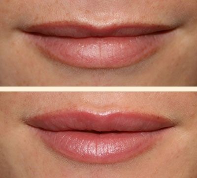 Botox ajkak, növelve az ajkak Botox - hatások, áttekintésre, fotó, videó