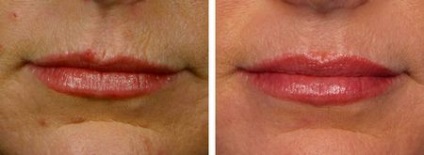 Botox ajkak, növelve az ajkak Botox - hatások, áttekintésre, fotó, videó