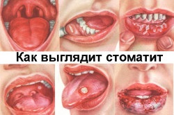 A stomatitis jellemzi szájpenész