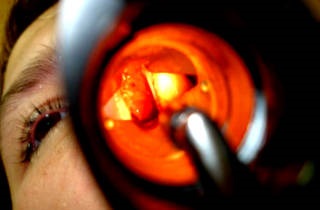 Mi a krónikus ethmoiditis - tünetek és kezelés (krónikus) Mi krónikus ethmoiditis - tünetek és kezelés