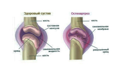 Deformáló osteoarthritis az ízületi a láb fokozat, tünetek, kezelés, népi jogorvoslati