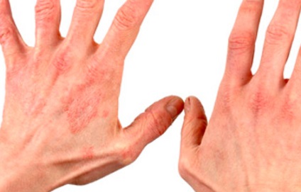kézen lévő bőrbetegségek)