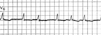 Elektromos alternans pitvarfibrillációban - ritmus és vezetési zavarok - Manual