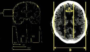 agyi echoencephalography (ehoes) olvasás, dekódolás eredménye