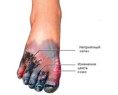 Előfordulhat, hogy a varikózisban a láb gangrénája van, Az alsó végtagok gangrénája