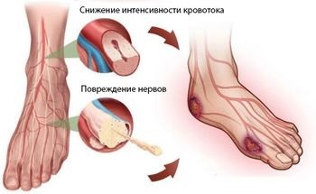 cukorbetegség a gangréna száraz kezelése)
