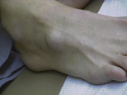 Hygroma lábon tünetek és a kezelés (hygroma) Hygroma a lábát tünetek és a kezelés