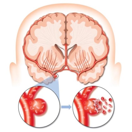 Ischaemiás stroke besorolás okai, tünetei, diagnózisa, kezelése