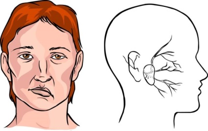 Ischaemiás stroke besorolás okai, tünetei, diagnózisa, kezelése