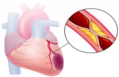 Ischaemiás stroke-ot a bal mellékhatások (balra) Ischaemiás stroke bal mellékhatások