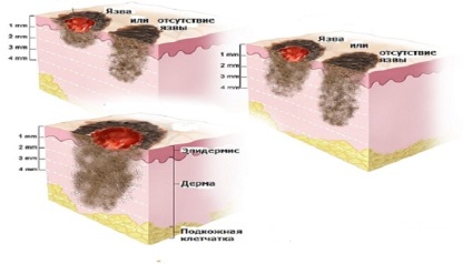 Milyen gyorsan fejleszteni melanoma egy anyajegy
