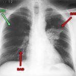 Hogyan lehet felismerni a tüneteket, a tuberkulózis és az első jelei a felnőtt korai szakaszában