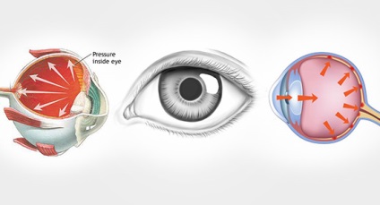 Hogyan lehet gyógyítani zárt zugú glaukóma, amíg nem gyógyítható, a szembetegség