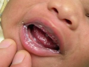A szájpenész: Candida a szájban