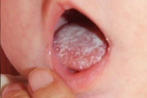 A szájpenész gyerekek (szájpenész) fényképes kezelésére csecsemők és serdülők