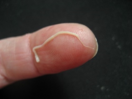pinworm kezelés emberben felfedezte a pinwormokat hogyan kell kezelni