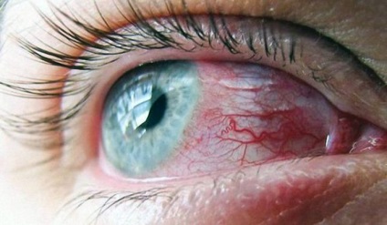Vörös vérerek fehérjék szem kezelésére és megelőzésére