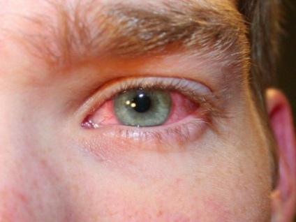 Red erek a fehérje okozza a szem
