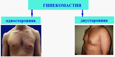 Lipomastiya (hamis gynecomastia) a férfiak - mi ez, kezelés, hogyan lehet megszabadulni előtti és utáni képek