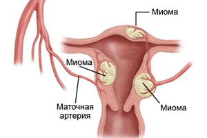 Міома тіла матки - лікування, симптоми, фото