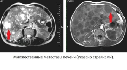 MR peritoneális üregbe és a hashártya mögötti térben (kontraszt)