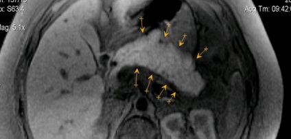 MR peritoneális üregbe és a hashártya mögötti térben (kontraszt)