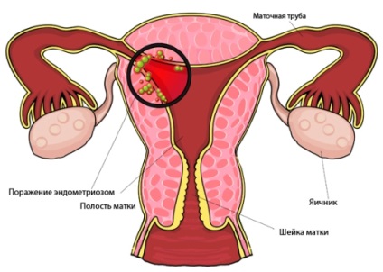 MRI a méh és a petefészkek képzés ár és contra