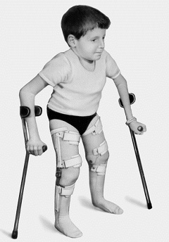 Osteogenesis imperfecta - kezelés, okai, típusai