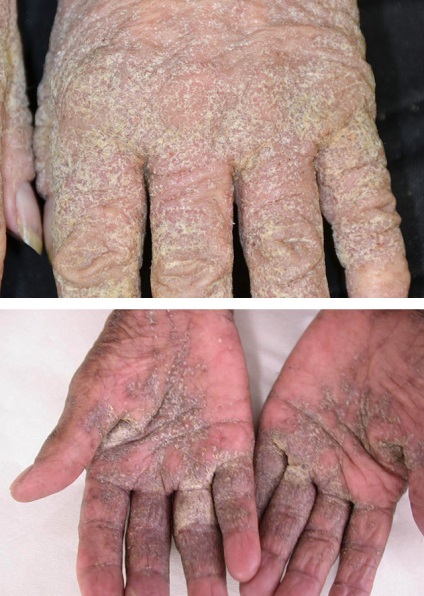 Norwegian rüh (krustoznaya) tünetei, kezelése, úgy néz ki, mint egy bőrbetegség, és hogyan