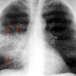 Focal tüdőgyulladás gyermekek tünetei és kezelése, jobb és bal oldali lekgo gyulladás,
