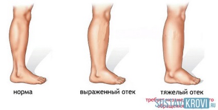 diabetes fájdalom láb kezelésére emberek jogorvoslatok)